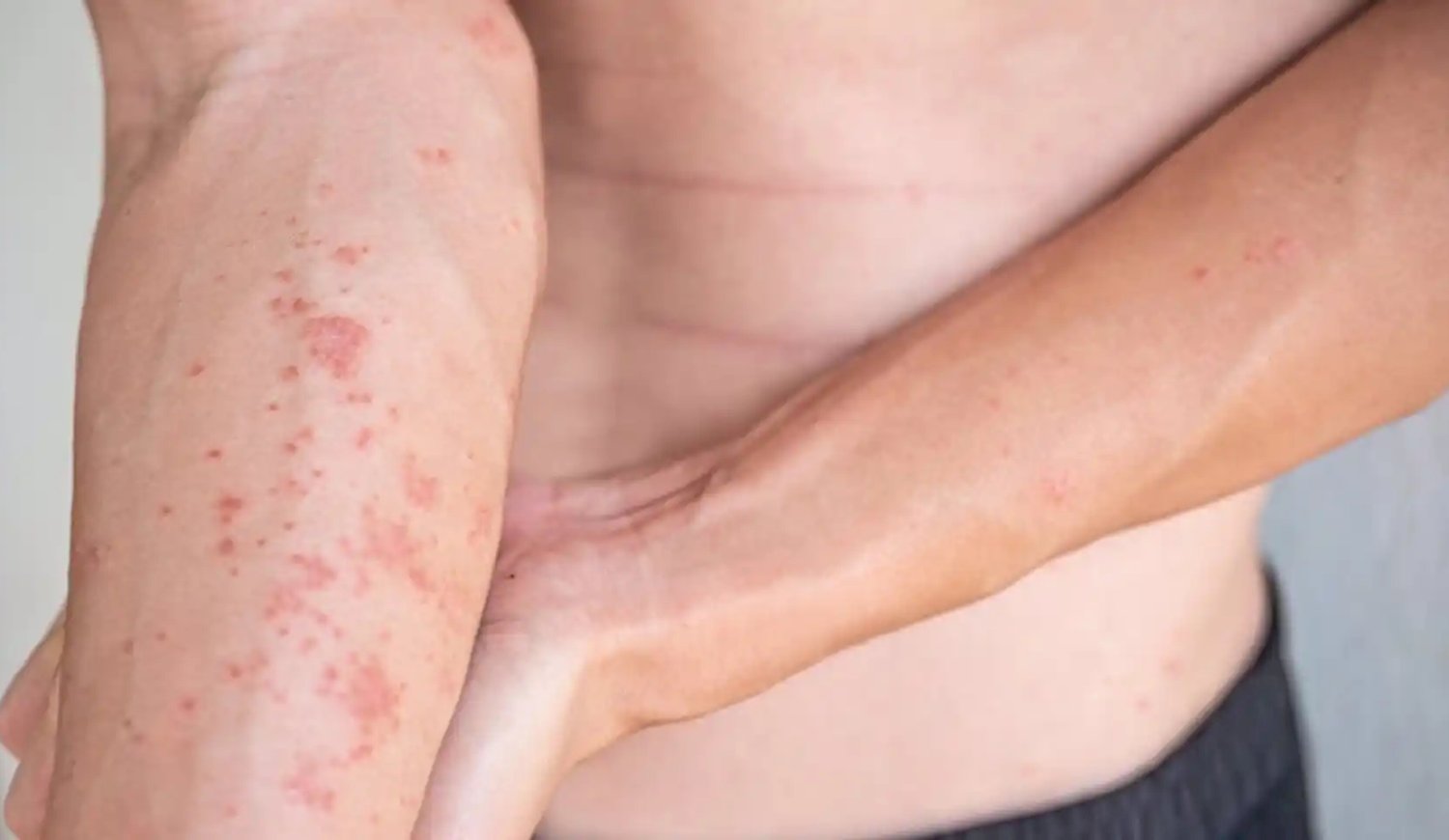 Paciente con dermatitis atópica en antebrazo.