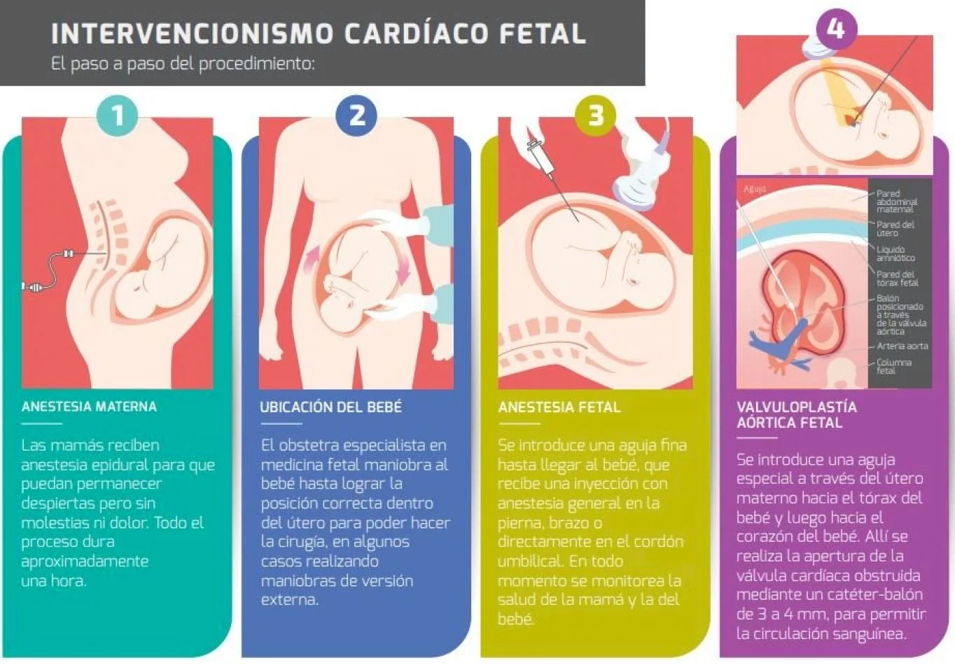 La cirugía cardíaca fetal que salva la vida de los bebés en el útero